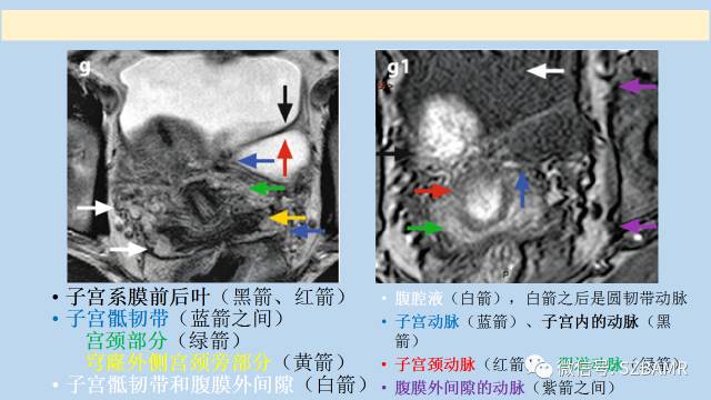 【PPT】女性盆腔、会阴影像解剖与肿瘤定位