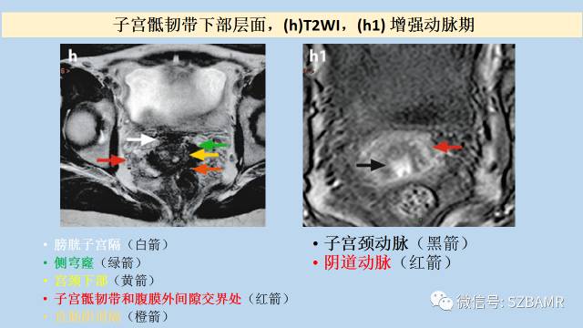 【PPT】女性盆腔、会阴影像解剖与肿瘤定位