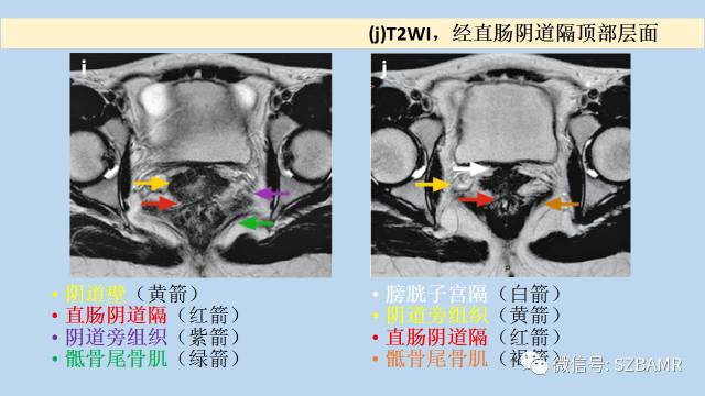 【PPT】女性盆腔、会阴影像解剖与肿瘤定位