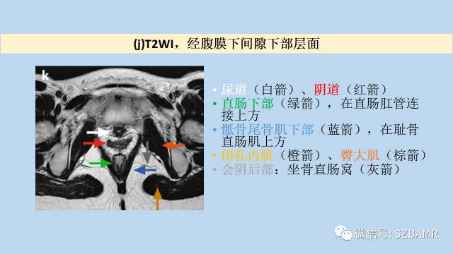 【PPT】女性盆腔、会阴影像解剖与肿瘤定位