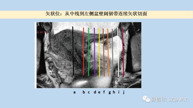 【PPT】女性盆腔、会阴影像解剖与肿瘤定位