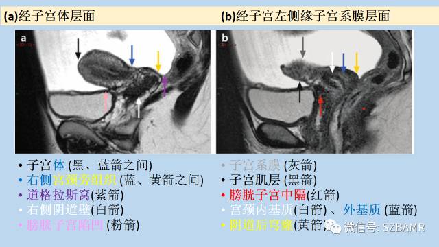 【PPT】女性盆腔、会阴影像解剖与肿瘤定位
