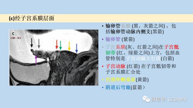 【PPT】女性盆腔、会阴影像解剖与肿瘤定位