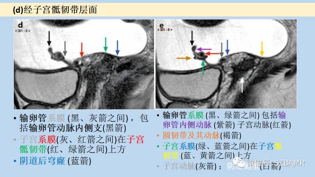 【PPT】女性盆腔、会阴影像解剖与肿瘤定位