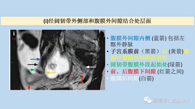 【PPT】女性盆腔、会阴影像解剖与肿瘤定位