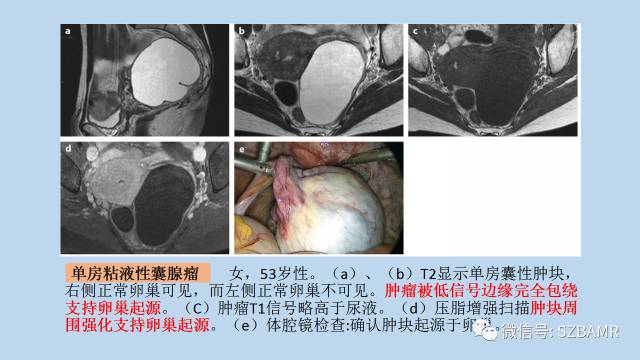 【PPT】女性盆腔、会阴影像解剖与肿瘤定位