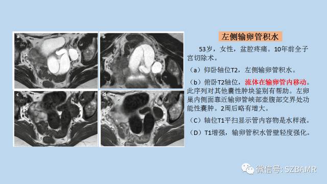 【PPT】女性盆腔、会阴影像解剖与肿瘤定位