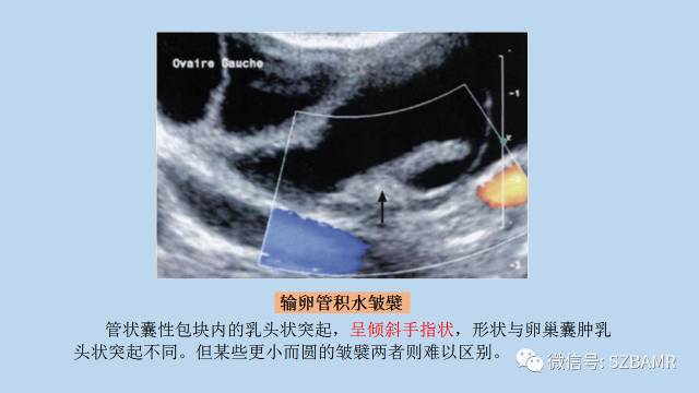【PPT】女性盆腔、会阴影像解剖与肿瘤定位
