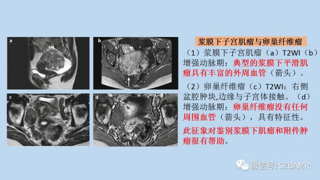 【PPT】女性盆腔、会阴影像解剖与肿瘤定位