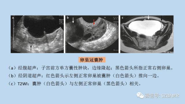 【PPT】女性盆腔、会阴影像解剖与肿瘤定位