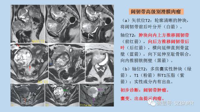 【PPT】女性盆腔、会阴影像解剖与肿瘤定位