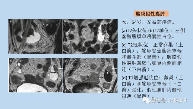 【PPT】女性盆腔、会阴影像解剖与肿瘤定位