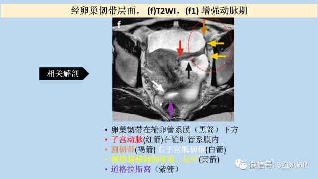 【PPT】女性盆腔、会阴影像解剖与肿瘤定位