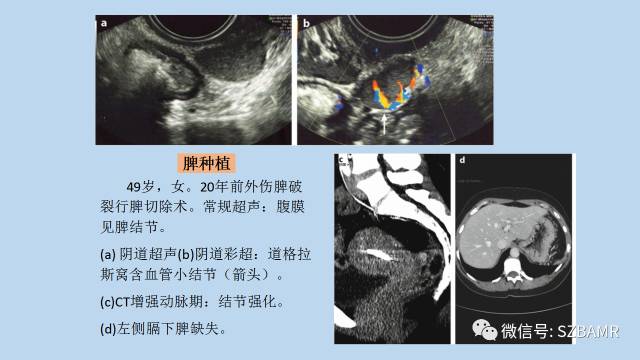 【PPT】女性盆腔、会阴影像解剖与肿瘤定位