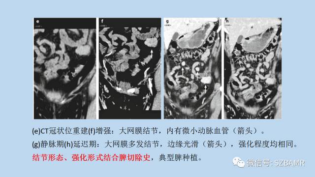 【PPT】女性盆腔、会阴影像解剖与肿瘤定位