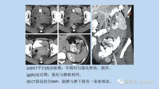【PPT】女性盆腔、会阴影像解剖与肿瘤定位