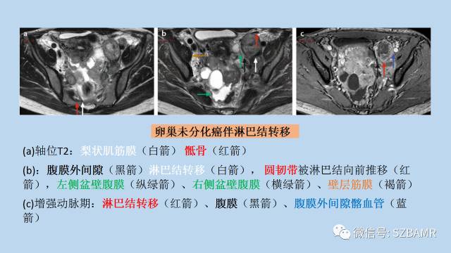 【PPT】女性盆腔、会阴影像解剖与肿瘤定位