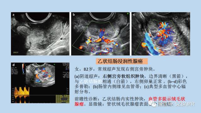 【PPT】女性盆腔、会阴影像解剖与肿瘤定位