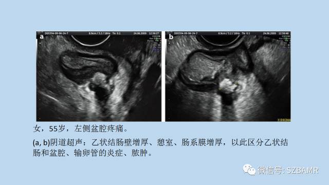 【PPT】女性盆腔、会阴影像解剖与肿瘤定位