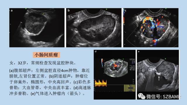 【PPT】女性盆腔、会阴影像解剖与肿瘤定位