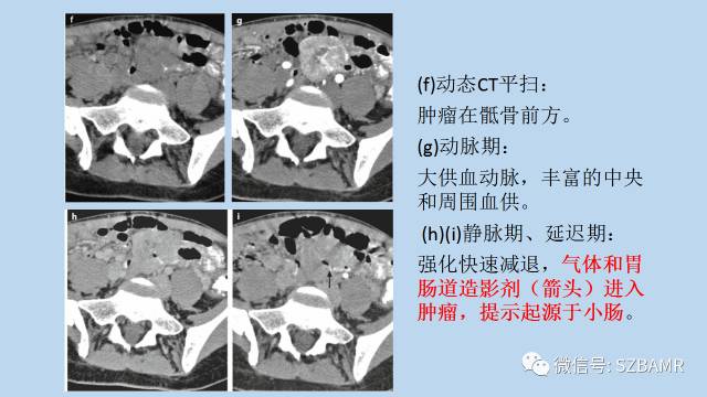 【PPT】女性盆腔、会阴影像解剖与肿瘤定位