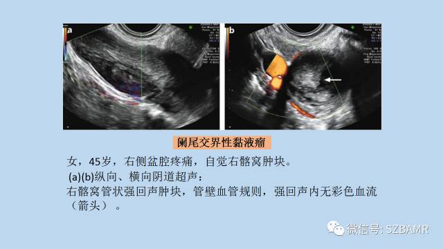 【PPT】女性盆腔、会阴影像解剖与肿瘤定位