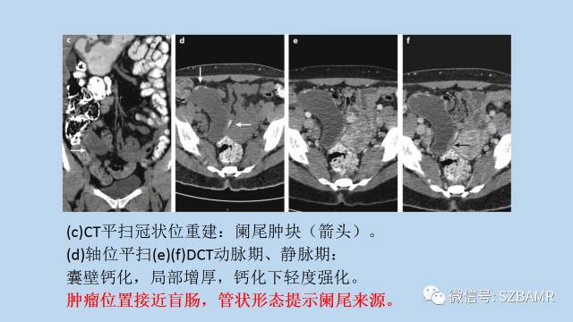 【PPT】女性盆腔、会阴影像解剖与肿瘤定位