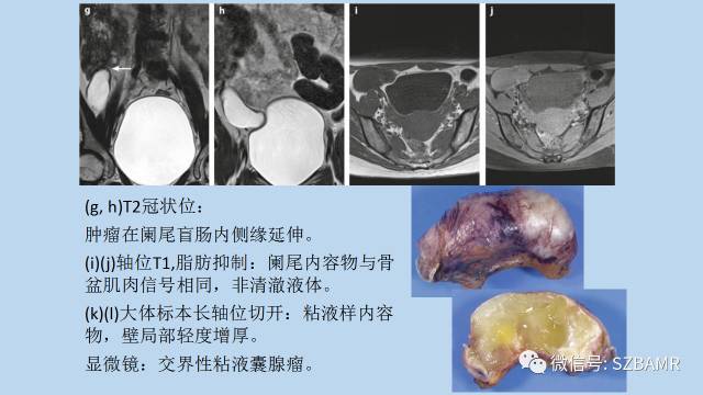【PPT】女性盆腔、会阴影像解剖与肿瘤定位