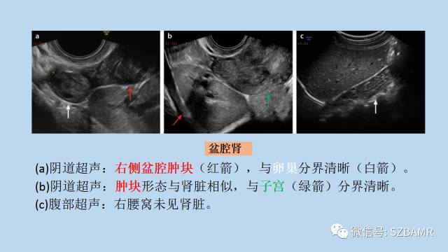 【PPT】女性盆腔、会阴影像解剖与肿瘤定位