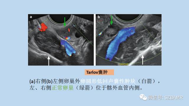 【PPT】女性盆腔、会阴影像解剖与肿瘤定位