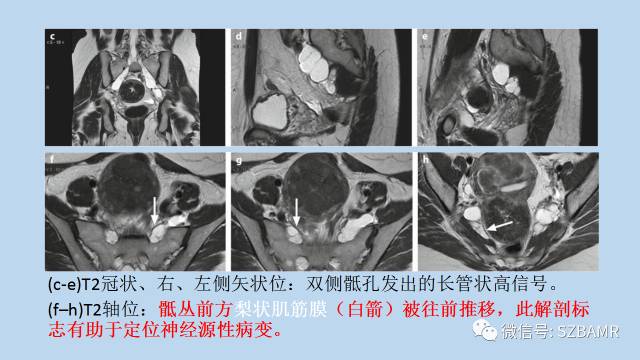 【PPT】女性盆腔、会阴影像解剖与肿瘤定位