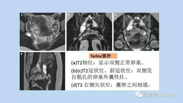 【PPT】女性盆腔、会阴影像解剖与肿瘤定位