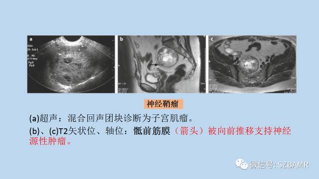 【PPT】女性盆腔、会阴影像解剖与肿瘤定位