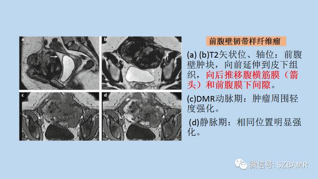 【PPT】女性盆腔、会阴影像解剖与肿瘤定位