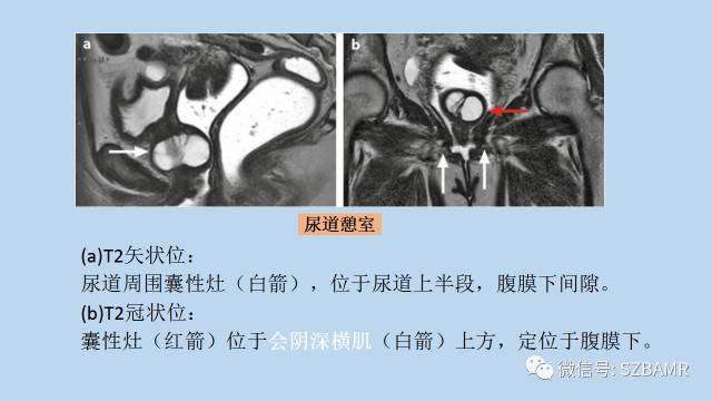 【PPT】女性盆腔、会阴影像解剖与肿瘤定位