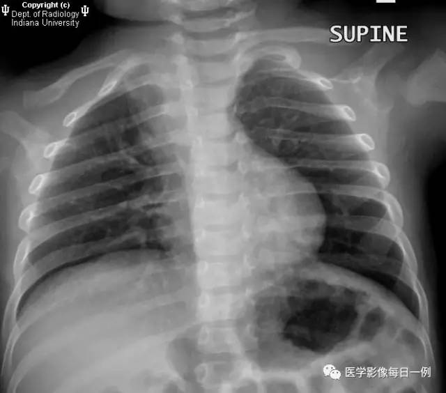 【病例】右位主动脉弓并迷走左锁骨下动脉1例CT 【病例】右位主动脉弓并迷走左锁骨下动脉1例CT