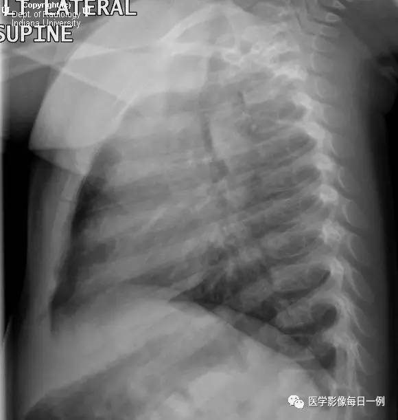 【病例】右位主动脉弓并迷走左锁骨下动脉1例CT 【病例】右位主动脉弓并迷走左锁骨下动脉1例CT