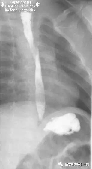【病例】右位主动脉弓并迷走左锁骨下动脉1例CT 【病例】右位主动脉弓并迷走左锁骨下动脉1例CT