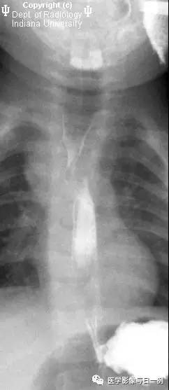 【病例】右位主动脉弓并迷走左锁骨下动脉1例CT 【病例】右位主动脉弓并迷走左锁骨下动脉1例CT