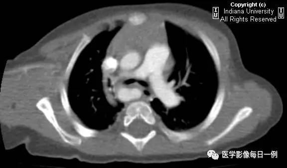 【病例】右位主动脉弓并迷走左锁骨下动脉1例CT 【病例】右位主动脉弓并迷走左锁骨下动脉1例CT