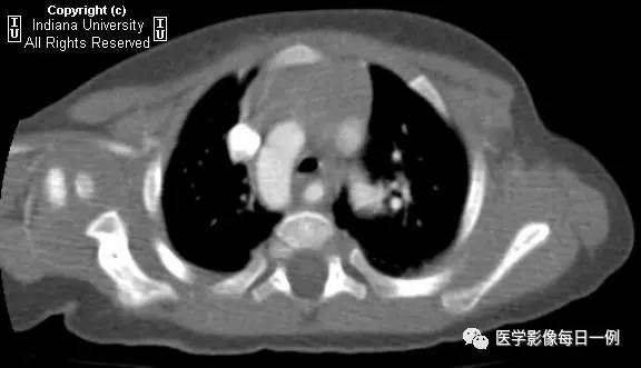 【病例】右位主动脉弓并迷走左锁骨下动脉1例CT 【病例】右位主动脉弓并迷走左锁骨下动脉1例CT
