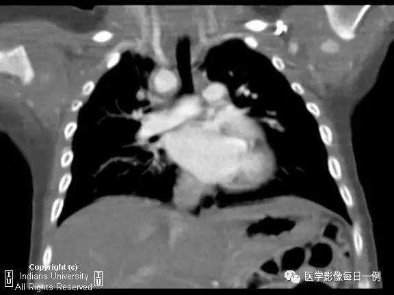 【病例】右位主动脉弓并迷走左锁骨下动脉1例CT 【病例】右位主动脉弓并迷走左锁骨下动脉1例CT