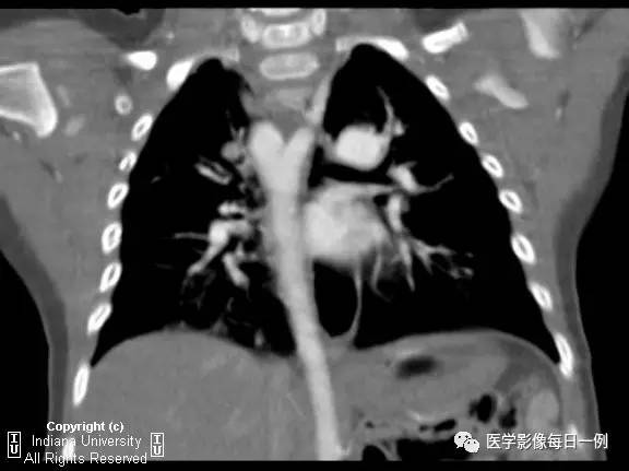【病例】右位主动脉弓并迷走左锁骨下动脉1例CT 【病例】右位主动脉弓并迷走左锁骨下动脉1例CT