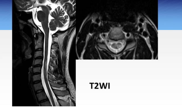 【病例】临床孤立综合征2例MR影像表现