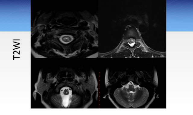【病例】临床孤立综合征2例MR影像表现