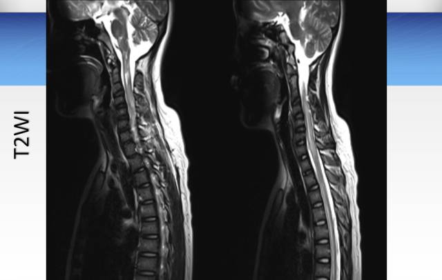 【病例】临床孤立综合征2例MR影像表现