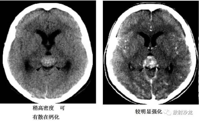 【病例】松果体区胶质瘤1例MR影像表现 【病例】松果体区胶质瘤1例MR影像表现