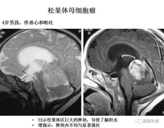 【病例】松果体区胶质瘤1例MR影像表现 【病例】松果体区胶质瘤1例MR影像表现