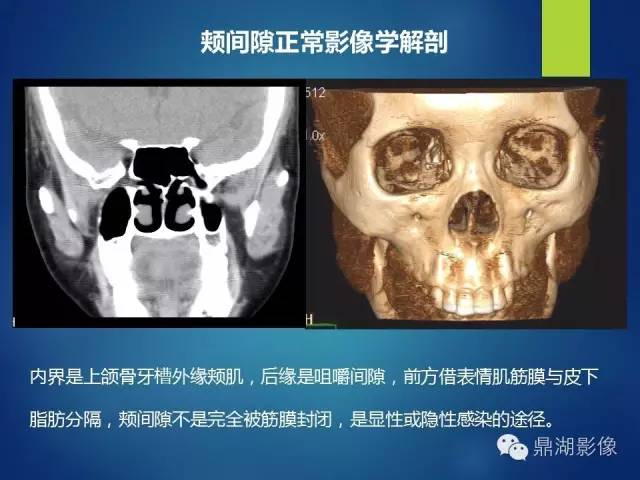 【PPT】颊间隙影像学解剖与病变的诊断