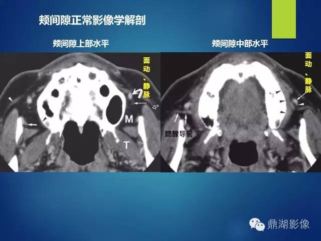 【PPT】颊间隙影像学解剖与病变的诊断